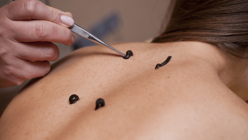 Illustration for article titled Best Leech Therapy Treatment In India